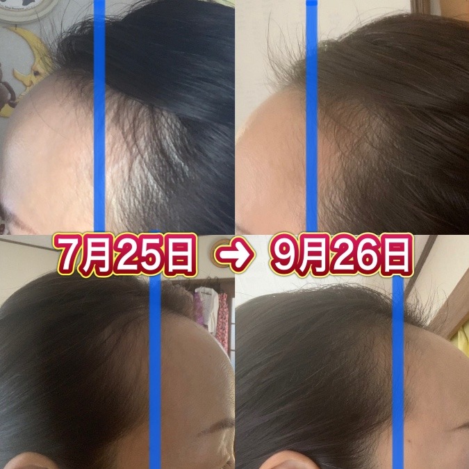 ヘアフィラー2ヶ月